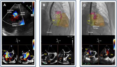 Case report: Transcatheter edge-to-edge repair after prior surgical tricuspid annuloplasty